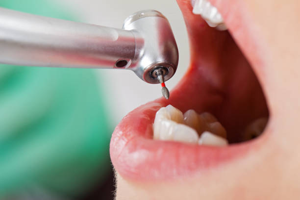 Best Chipped Tooth Repair Near Me  in Bunkie, LA